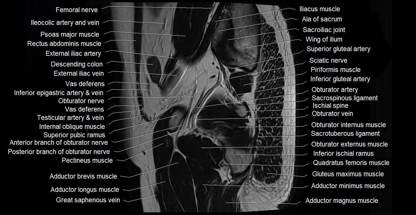 male pelvis sagittal cross sectional anatomy 3T mri image 9.webp
